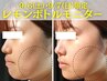 9/6・9/7限定｜脂肪分解剤レモンボトル2ccもしくはレモンボトルスキン1cc