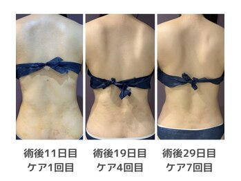 インディバ ミマリ(INDIBA ミマリ)/背中と腰の術後ケア