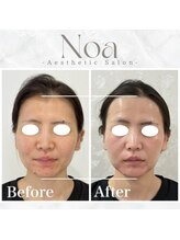 ノア 新宿(Noa)/小顔矯正＋ハーブピーリング 5回