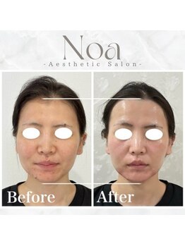 ノア 新宿(Noa)/小顔矯正+ハーブピーリング 5回