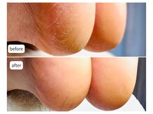 カシェット(Cachette)/50代女性◎足裏角質ケア90分