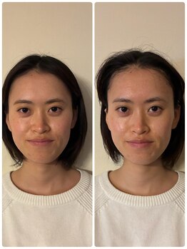 きよこのはり/セルフハーブピーリング