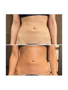 アクアンフィニィ(aquanfini)/内臓の位置を整え美しいくびれ