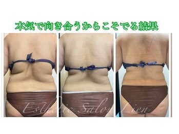 リアン 南熊本店(Lien)/毛穴改善・痩身・ダイエット