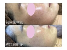 ストーリー 岐阜店(STORY)/ハーブピーリング専門店STORY