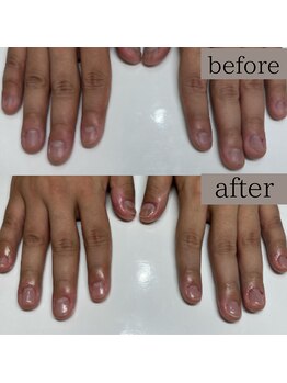 ティアラネイル 宇都宮/深爪矯正
