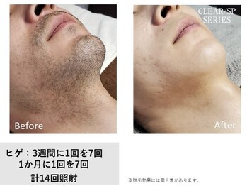 レア(Le'a)/【ヒゲ脱毛】