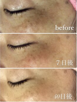 レイビューティー 一宮店(RAY+ Beauty)/マイクロニードル