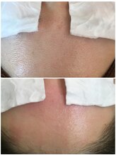 叶(Kanau)/毛穴エクストラクション1回