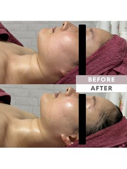 とぅるりん 肌質改善/一度で艶肌♪高リピート！！