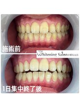 ホワイトニングサロン 京都烏丸店/ホワイトニング施術例