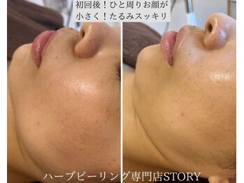 ストーリー 岐阜店(STORY)/ハーブピーリング専門店STORY
