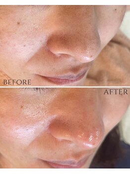 ザ ヴォーグ(the VOGUE)/毛穴を綺麗にしたいなら...