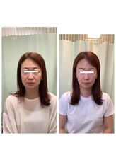 あらた鍼灸整骨院/美容鍼ビフォーアフター
