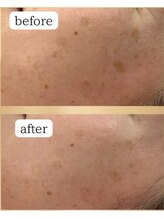 ブレス ザ モール郡山店(BLESS)/フェイシャル結果