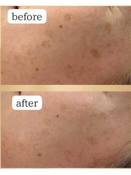 ブレス ザ モール郡山店(BLESS)/フェイシャル結果