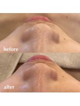 リモアボーテ(RIMOA beaute)/【毛穴】before→after