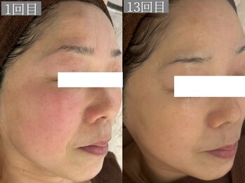 ホワイトアクア 鳳店(WHITE AQUA)/ララピール/毛穴/大阪/鳳