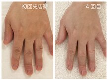 キレイテ 福岡天神店/40代/4回目【大名ハンドケア】