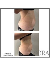 青空 天神大名店(SORA)/オンダリフトボディ1回