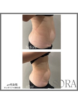 青空 天神大名店(SORA)/オンダリフトボディ1回