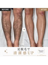 テディベース(TEDDY BASE)/メンズ脱毛で自己処理卒業。