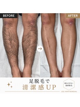 テディベース(TEDDY BASE)/メンズ脱毛で自己処理卒業。