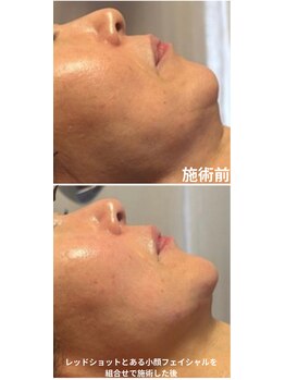サロンドエムジョリー 横浜(Salon de M jolie)の写真/【注目度No.1脂肪分解レモンボトル 】脂肪を分解・排出し小顔効果◎エイジングにはレッドショットも