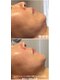 サロンドエムジョリー 横浜(Salon de M jolie)の写真/【注目度No.1脂肪分解レモンボトル 】脂肪を分解・排出し小顔効果◎エイジングにはレッドショットも