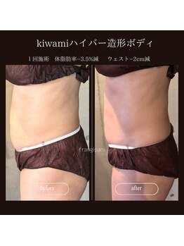 フランジパニ(FRANGIPANI)の写真/従来の燃焼ケアより少ない回数で効果実感♪最新マシンkiwami×脂肪分解溶液年齢で痩せづらいと感じる方にも