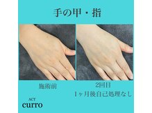 アクト クロ(ACT curro)/【手の甲・指】脱毛施術例