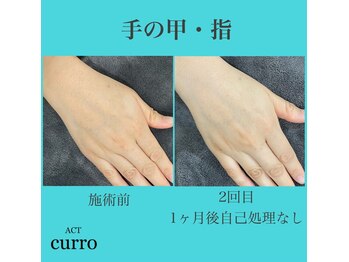 アクト クロ(ACT curro)/【手の甲・指】脱毛施術例