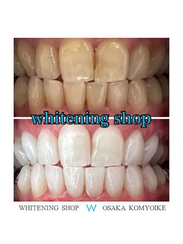 ホワイトニングショップ 光明池店/【ビフォーアフター】10回