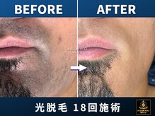 ロミオワックス ジュリエットワックス 新宿店(ROMEO Wax Juliet Wax)/ロミオワックスのヒゲ脱毛