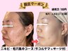 【期間限定】夏直前肌質改善！毛穴×ニキビケア集中トリートメント
