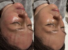 アンティアージュ 福岡本店(antiage)/赤み・ニキビ 敏感肌に