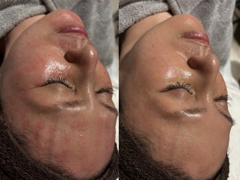 アンティアージュ 福岡本店(antiage)/赤み・ニキビ 敏感肌に