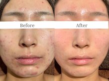 ニキビや肌トラブルの原因にアプローチ！再生修復させる☆