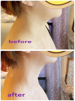 アリス 赤坂/肩こりと盛り肩