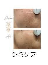 サンカリビューティー(SANKARI beauty)/シミ・くすみケア