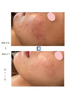 アイリス(AIRIS)/フェイシャル/毛穴ケア/美白