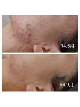 ビラ ベルダ(Bira Beldad)/ニキビケア