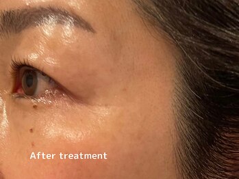 オアシスラグーン(OASIS LAGOON)/しわケア(症例1:after)