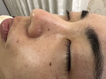 リコリス(Lycoris)/毛穴洗浄