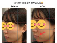ベル/20代の方の小顔Before After