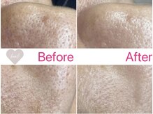 ベアール(beal)/毛穴特化ハーブピーリング