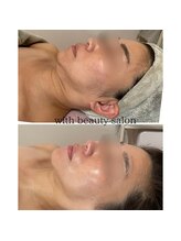 ウィズ(with)/REVIハーブピーリング×白玉WAX