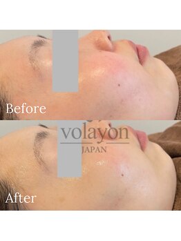 ポピン(POPIN)/瞬時に水分供給!ヒアロテン管理