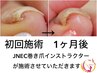 《巻き爪陥入爪トラブル爪対応》足のトラブル爪にお困りの方★