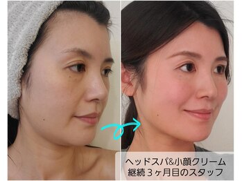 プリマ(prima)/ほうれい線と疲れ顔が悩みでした